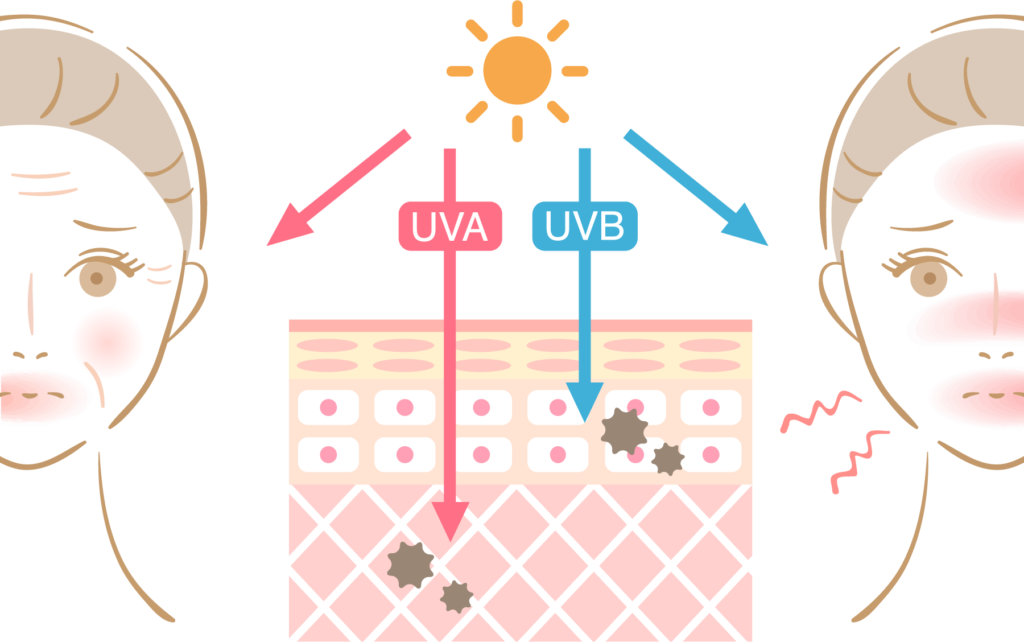 お肌のダメージで一番影響を受けやすいのが紫外線です。紫外線は「UVA」と「UVB」と分かれており、それぞれお肌に与える影響が違います。「UVA」は肌の真皮まで届き、肌を黒くする紫外線です。窓ガラスや曇り空でも通過して肌の奥深く真皮まで届き、シワやたるみの原因になります。「UVB」は、表皮に作用するため、日差しを長時間浴びると赤く炎症を起こす紫外線です。炎症がおさまると黒く変わります。メラニンを増加させてシミの原因になります。どちらの紫外線も光老化を促す為、対策が必要です。